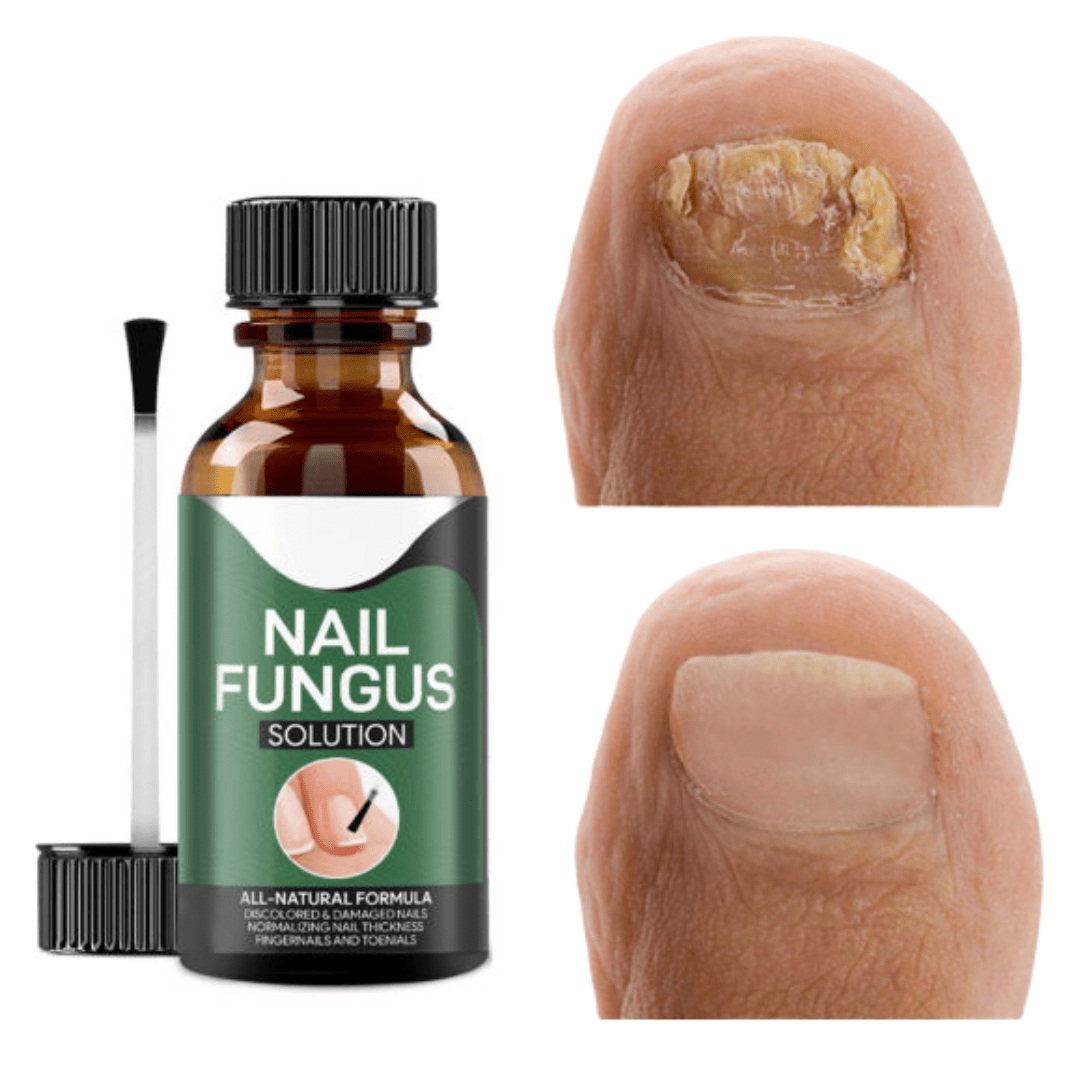 Krople do Leczenia Grzybicy Paznokci – Naturalne Olejki, 15 ml 0