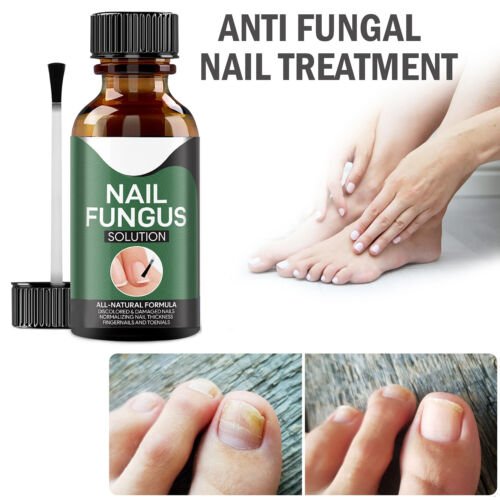 Krople do Leczenia Grzybicy Paznokci – Naturalne Olejki, 15 ml 2