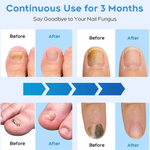 Laserowe Urządzenie do Leczenia Grzybicy Paznokci - Przenośne, Bez Chemikaliów, Efektywna Terapia 6