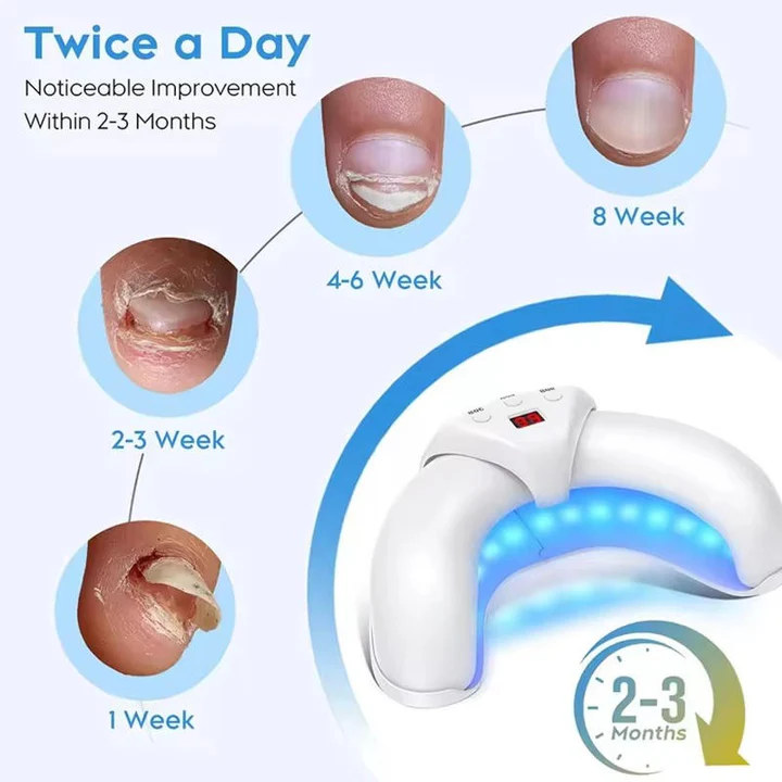 Laserowe Urządzenie do Leczenia Grzybicy Paznokci - Przenośne, Bez Chemikaliów, Efektywna Terapia 8