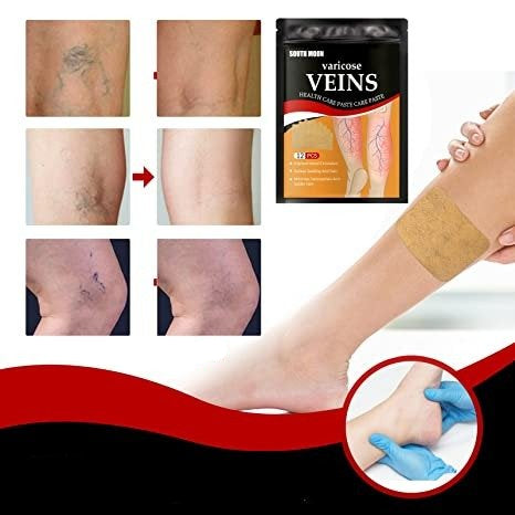 Plaster Leczacy Żylaki - Naturalna Pielęgnacja Nóg i Ulga w Obrzękach 3
