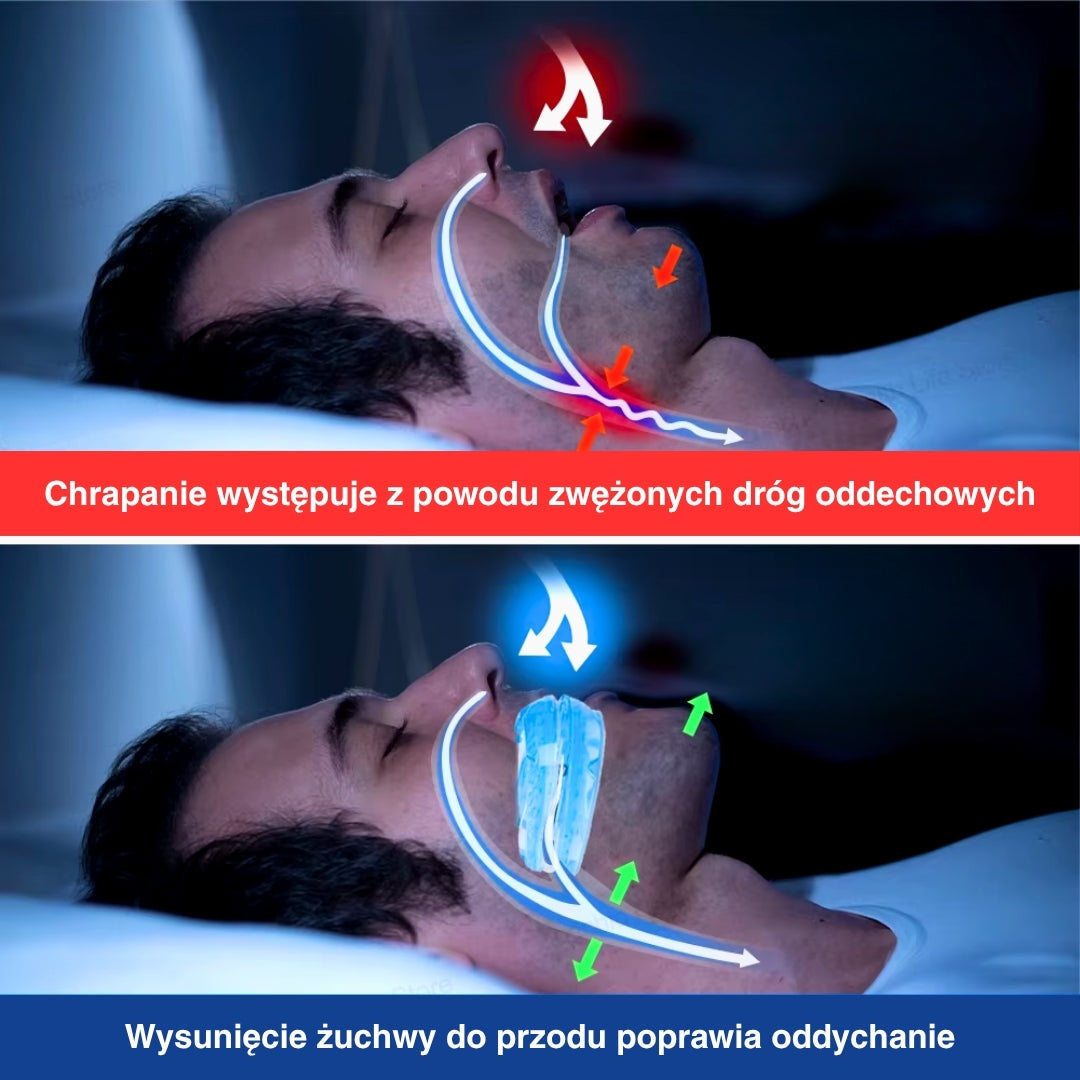 Porównanie dróg oddechowych z regulowanym ustnikiem do spania i bez niego, wykazujące poprawę przepływu powietrza